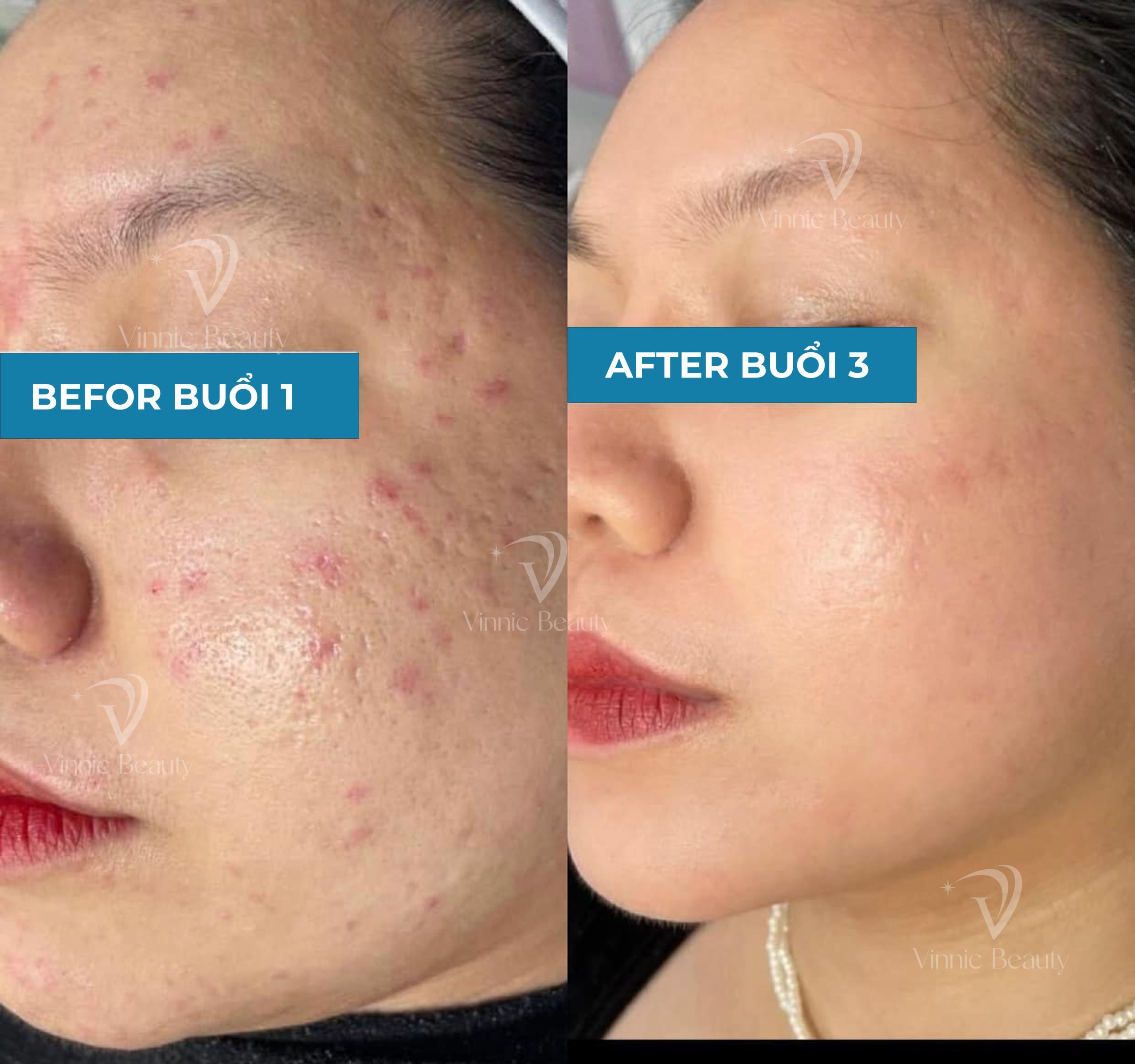 Ứng Dụng Công Nghệ Hiện Đại Trong Trị Sẹo Rỗ Tại Trung Tâm Vinnic Beauty 3 Form Befor After copy 2 e1775835609333