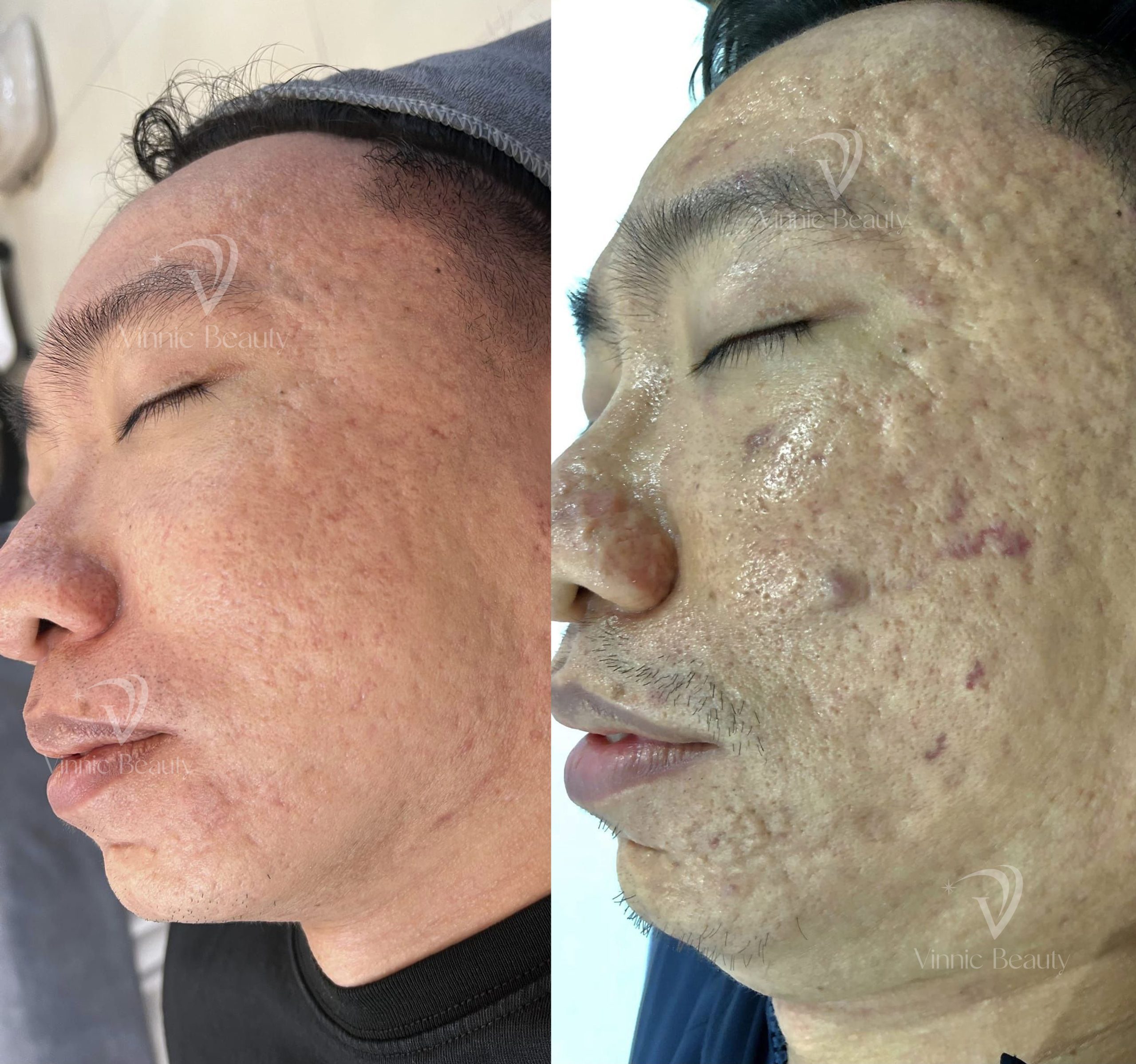 Ứng Dụng Công Nghệ Hiện Đại Trong Trị Sẹo Rỗ Tại Trung Tâm Vinnic Beauty 4 Form Befor After copy scaled e1775835567720