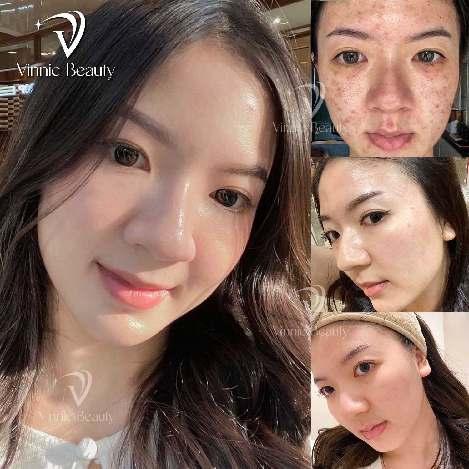 Phục hồi, nuôi dưỡng làn da khô, kích ứng với dịch vụ chăm sóc da Vinnic Beauty 2 Phục hồi, nuôi dưỡng làn da khô, kích ứng với dịch vụ chăm sóc da Vinnic Beauty (2)