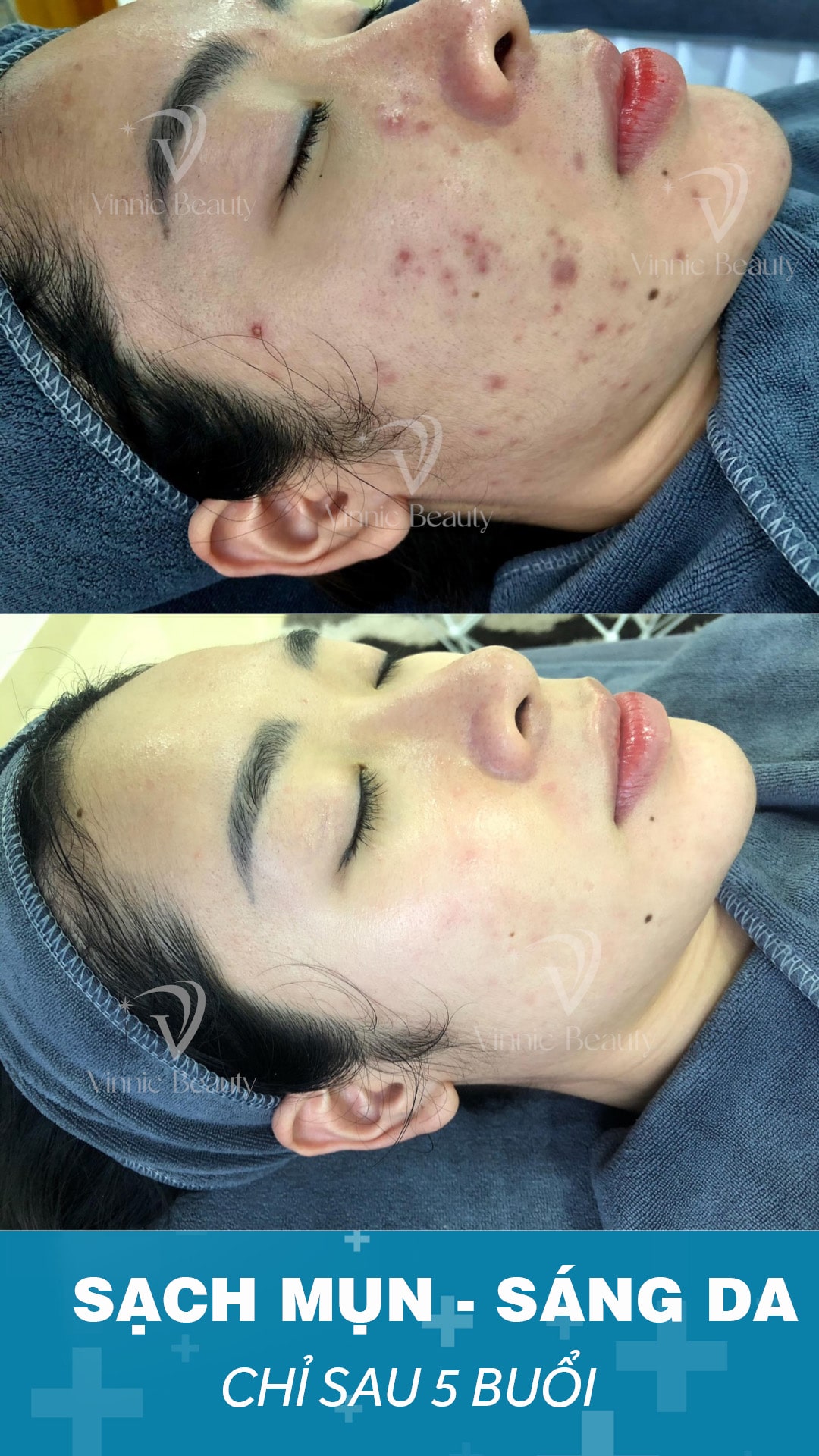 Trị Mụn Chuẩn Y Khoa Không Xâm Lấn Sạch Mụn Nhanh, Da Sáng Mịn Tự Nhiên (3)