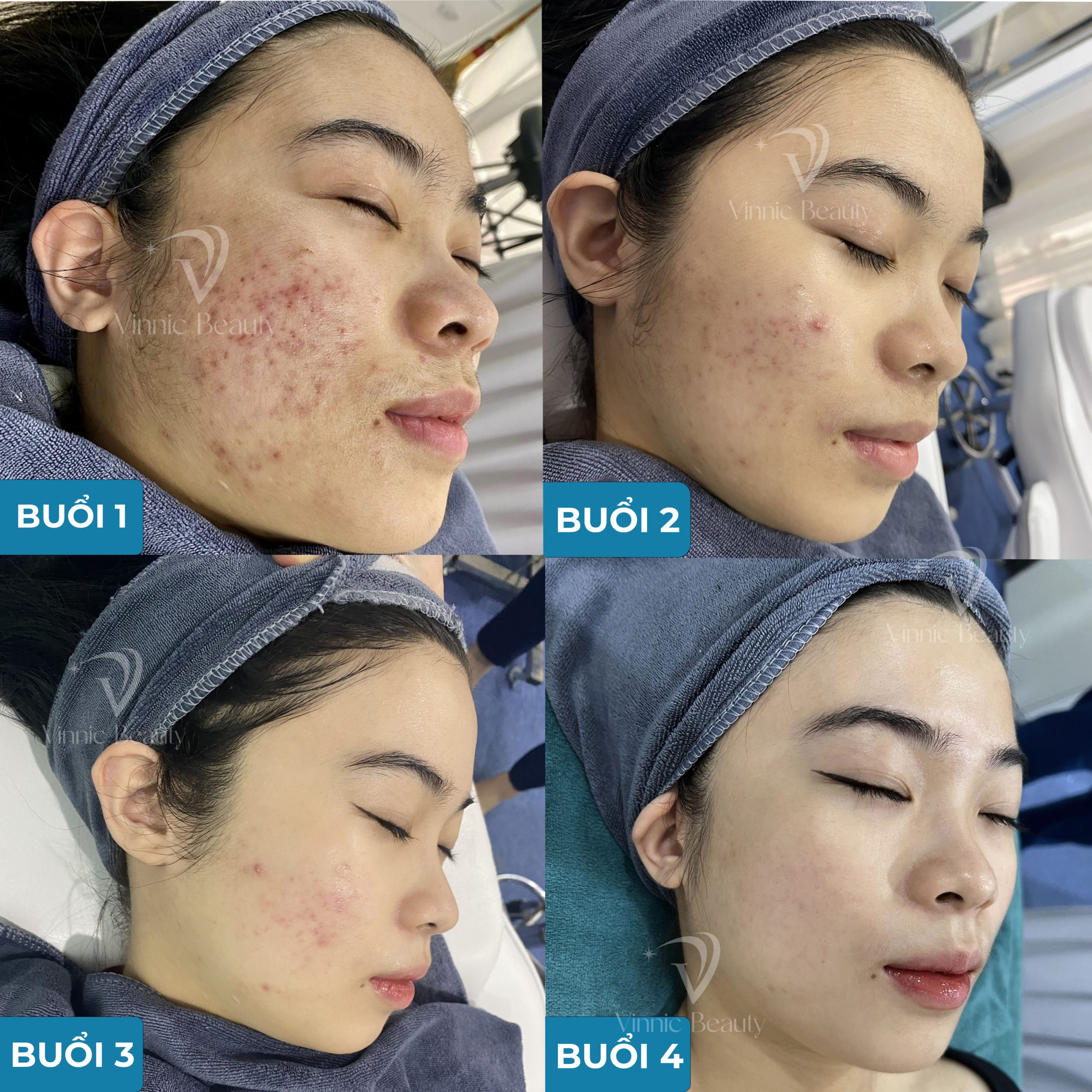 Mụn nhọt, mụn đầu đinh, đinh râu sưng đau? Đừng nặn nếu không muốn nhiễm trùng 4 mun a6 scaled