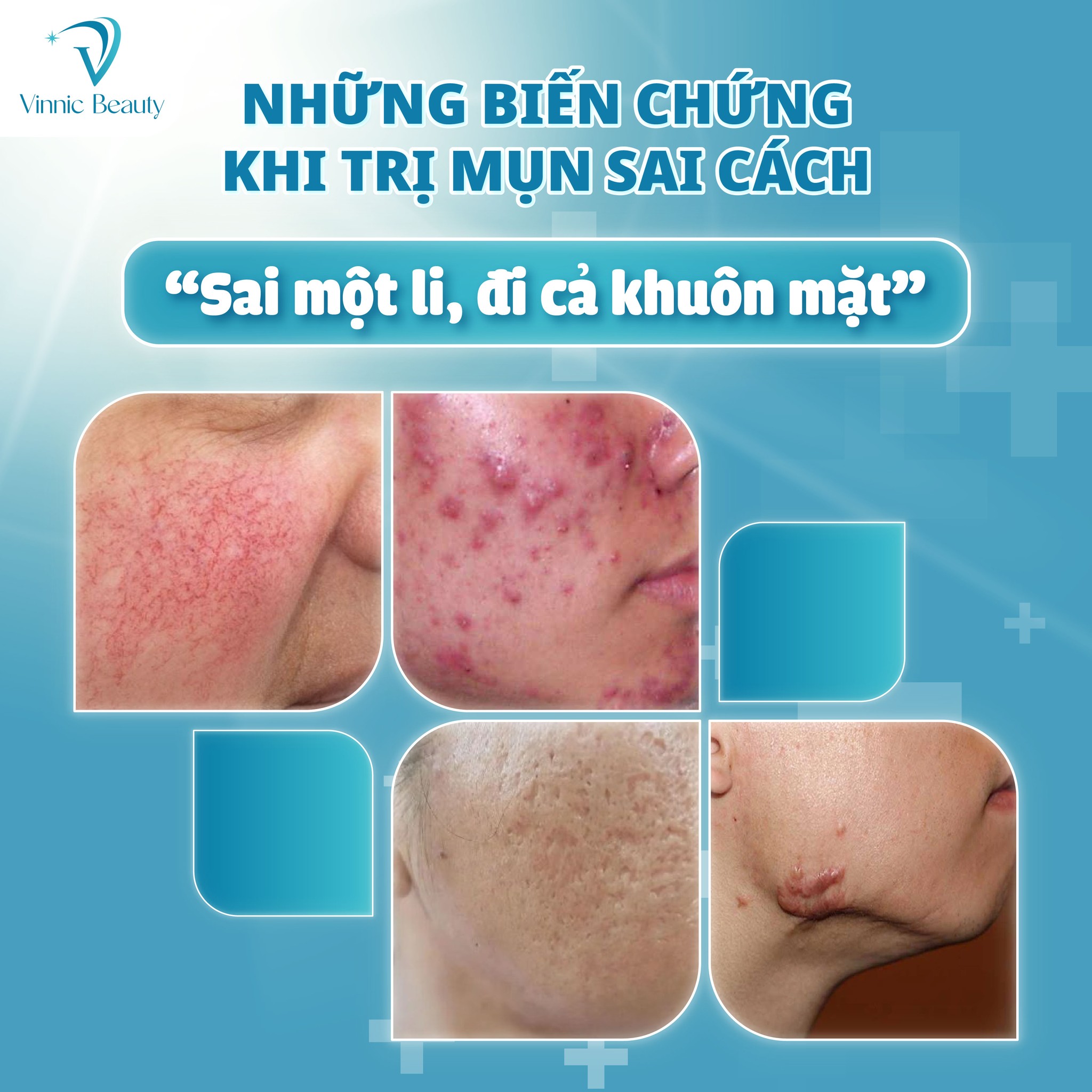 Làm sao để trị mụn tận gốc mà không để lại sẹo? 3 Làm sao để trị mụn tận gốc mà không để lại sẹo (1)