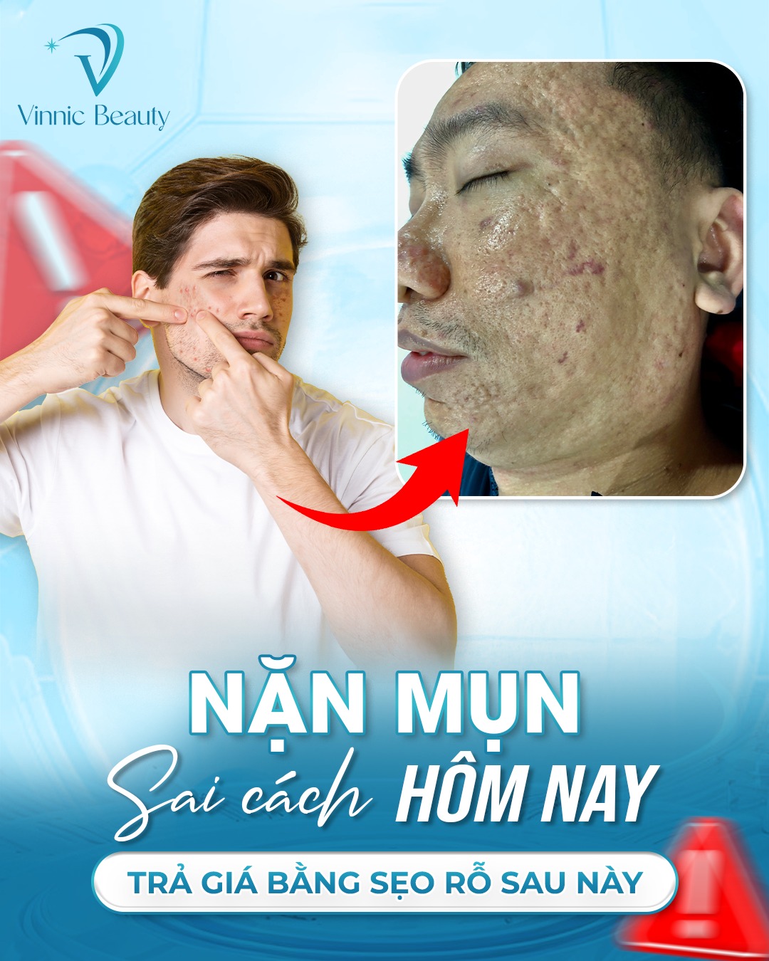Làm sao để trị mụn tận gốc mà không để lại sẹo (3)