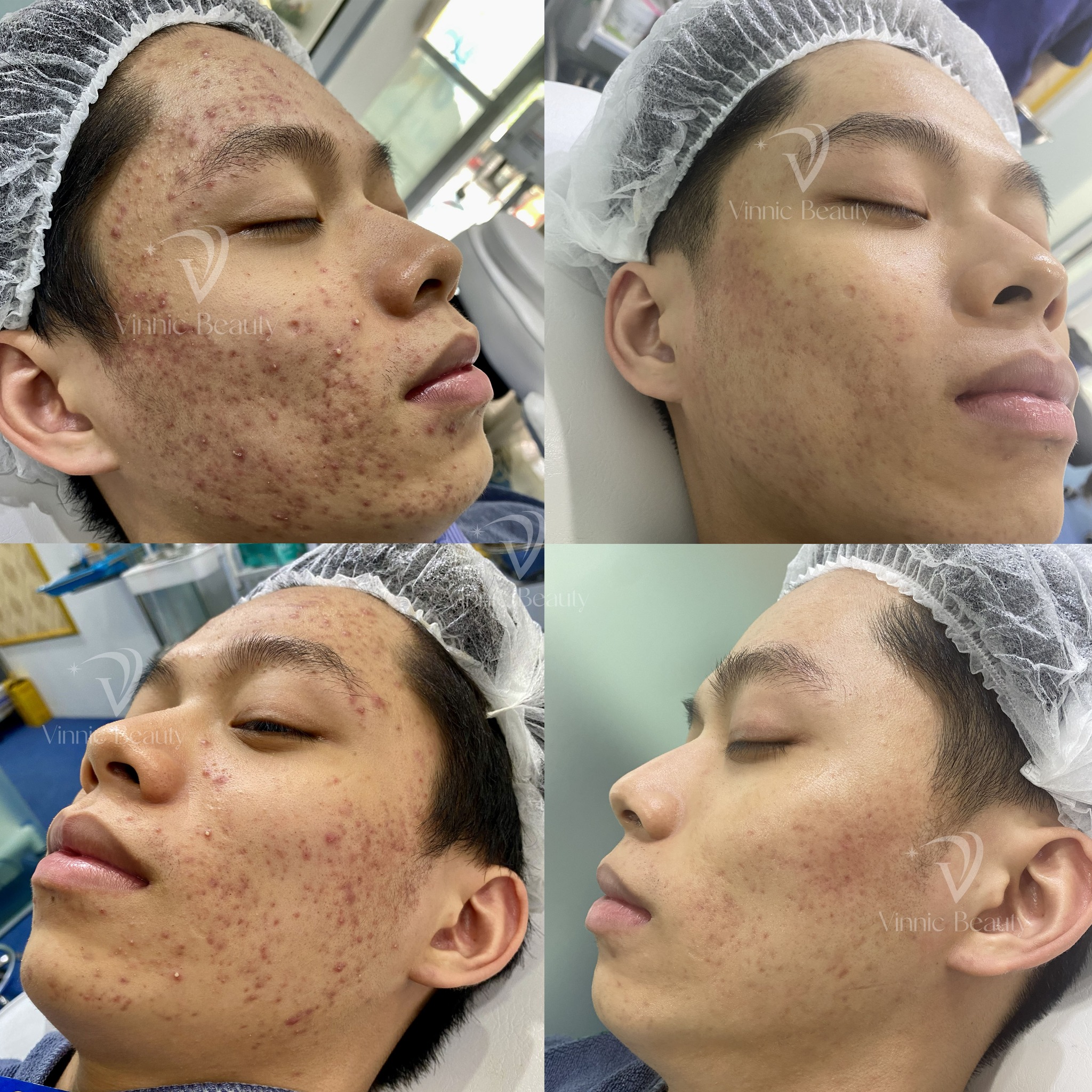 Lỗ Chân Lông To - Nạn Nhân Thầm Lặng Của Mụn Kéo Dài 3 Lỗ Chân Lông To - Nạn Nhân Thầm Lặng Của Mụn Kéo Dài (1)
