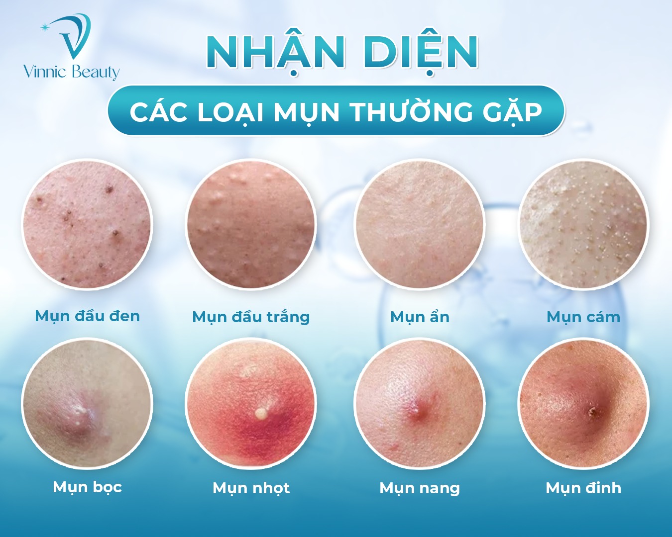 Lỗ Chân Lông To - Nạn Nhân Thầm Lặng Của Mụn Kéo Dài 4 Lỗ Chân Lông To - Nạn Nhân Thầm Lặng Của Mụn Kéo Dài (2)