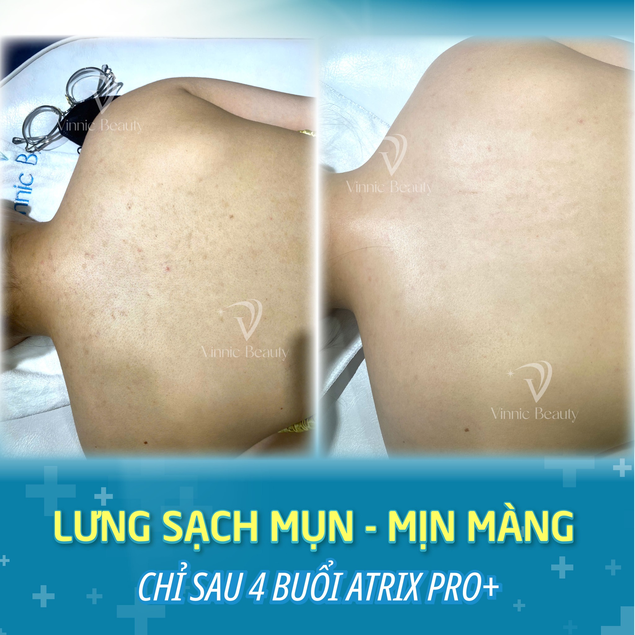 Mụn Lưng Ở Nữ Giới Do Hormone? Bí Quyết Khắc Phục Triệt Để 4 Mụn Lưng Ở Nữ Giới Do Hormon 2