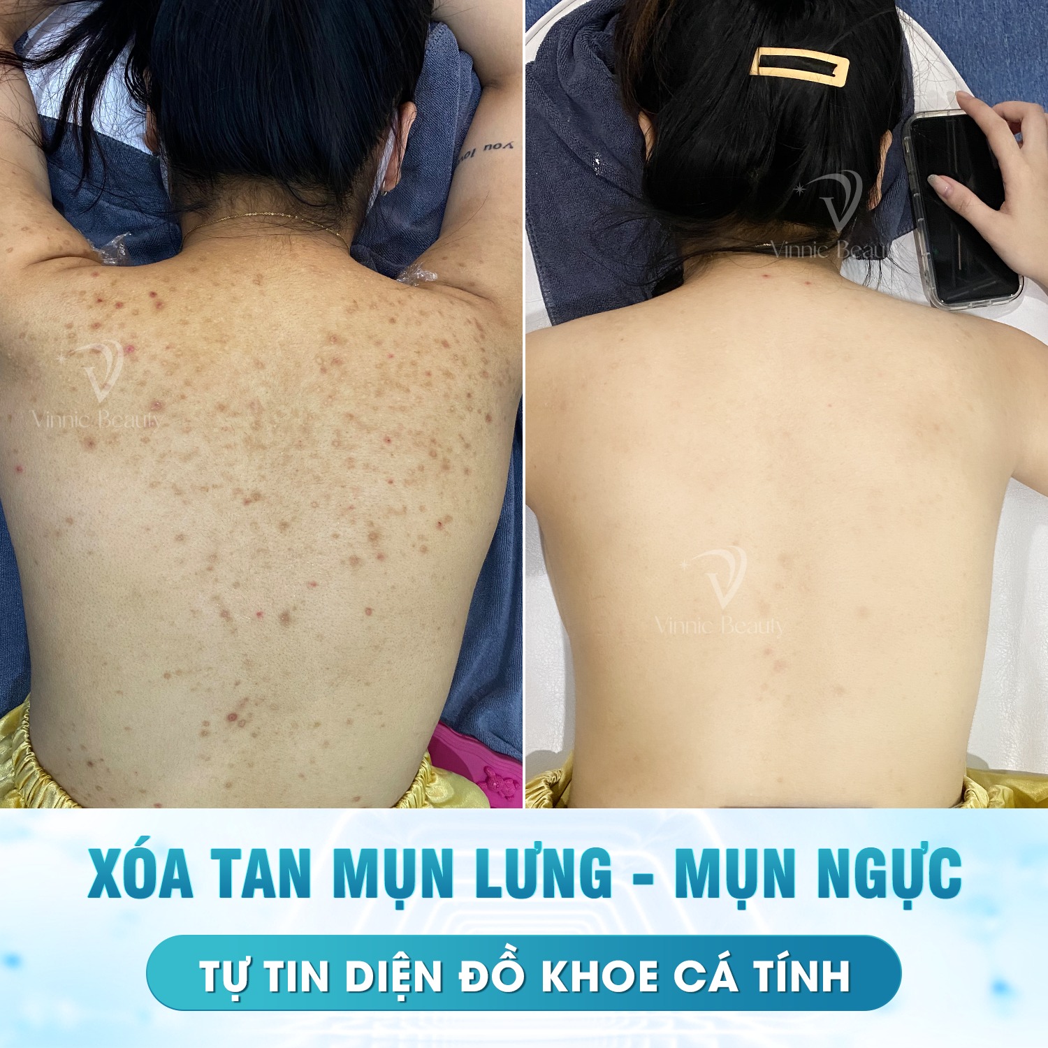 Mụn Lưng Ở Nữ Giới Do Hormon 3