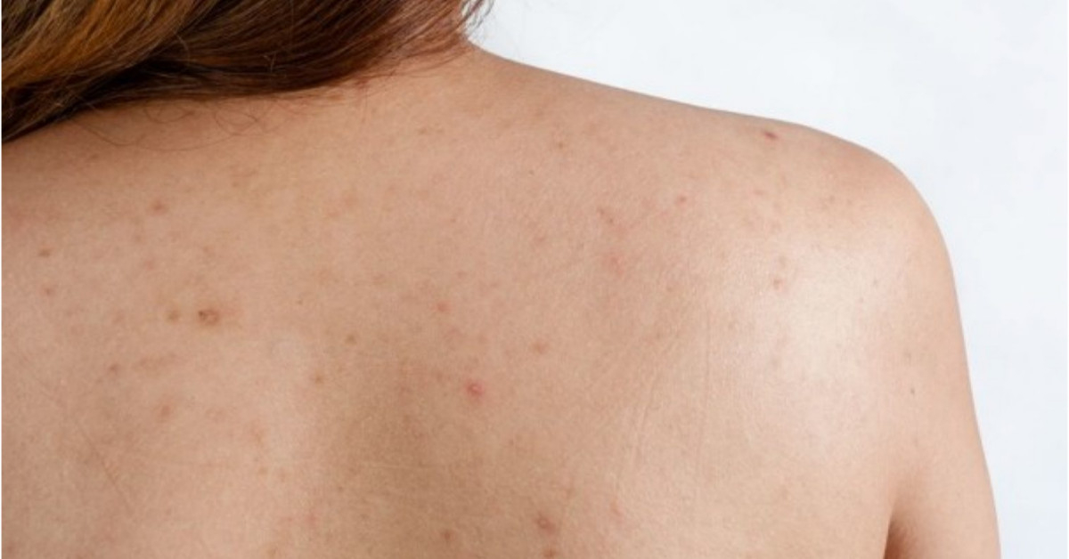 Mụn Lưng Ở Nữ Giới Do Hormone? Bí Quyết Khắc Phục Triệt Để 2 Mụn Lưng Ở Nữ Giới Do Hormon