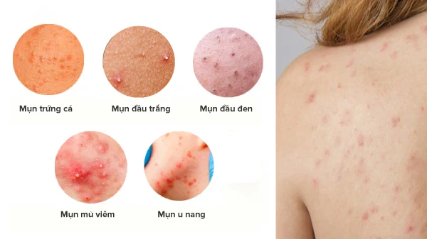 Mụn Lưng Ở Nữ Giới Do Hormone? Bí Quyết Khắc Phục Triệt Để 3 Mụn Lưng Ở Nữ Giới Do Hormon 1