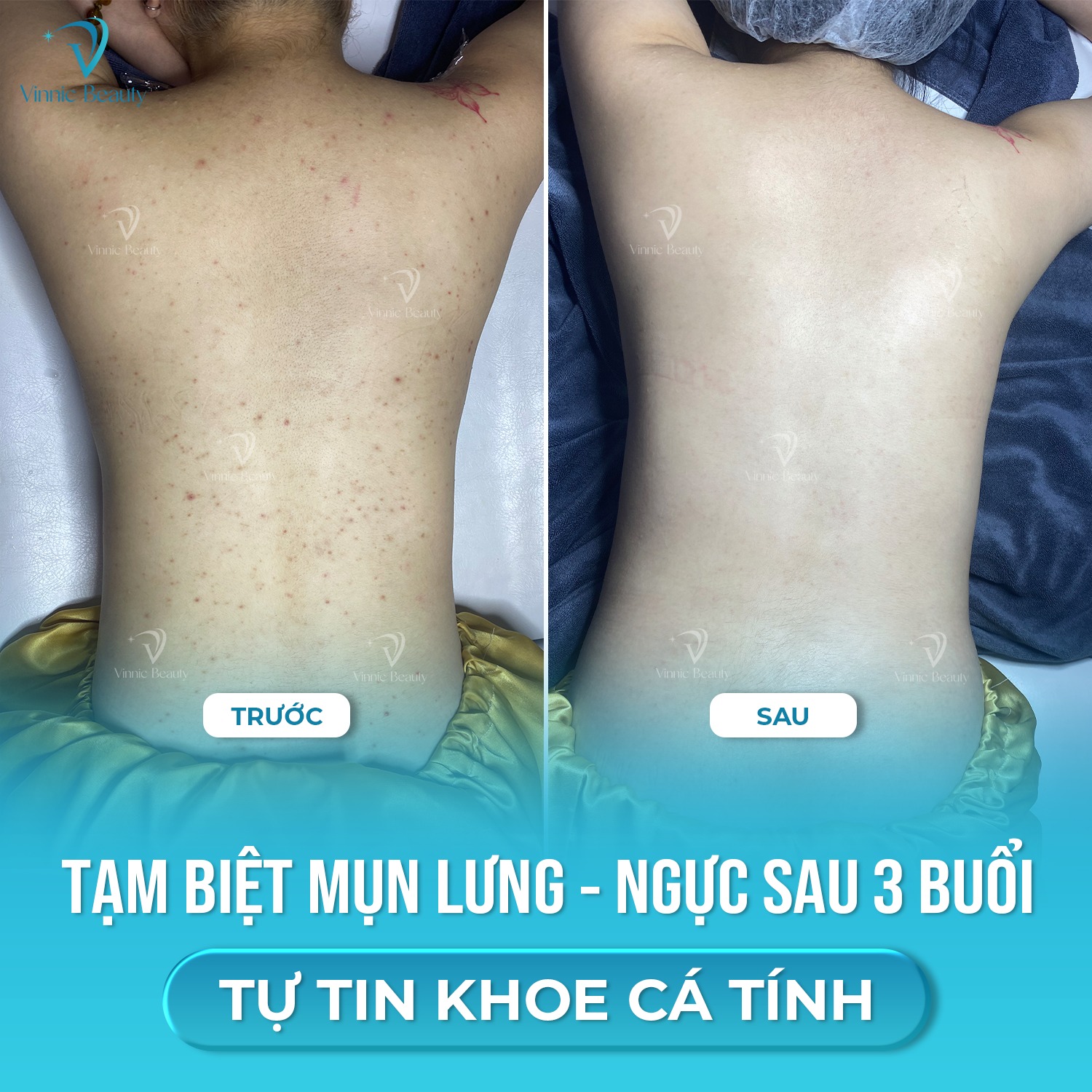 Mụn Lưng Tái Phát Liên Tục 2