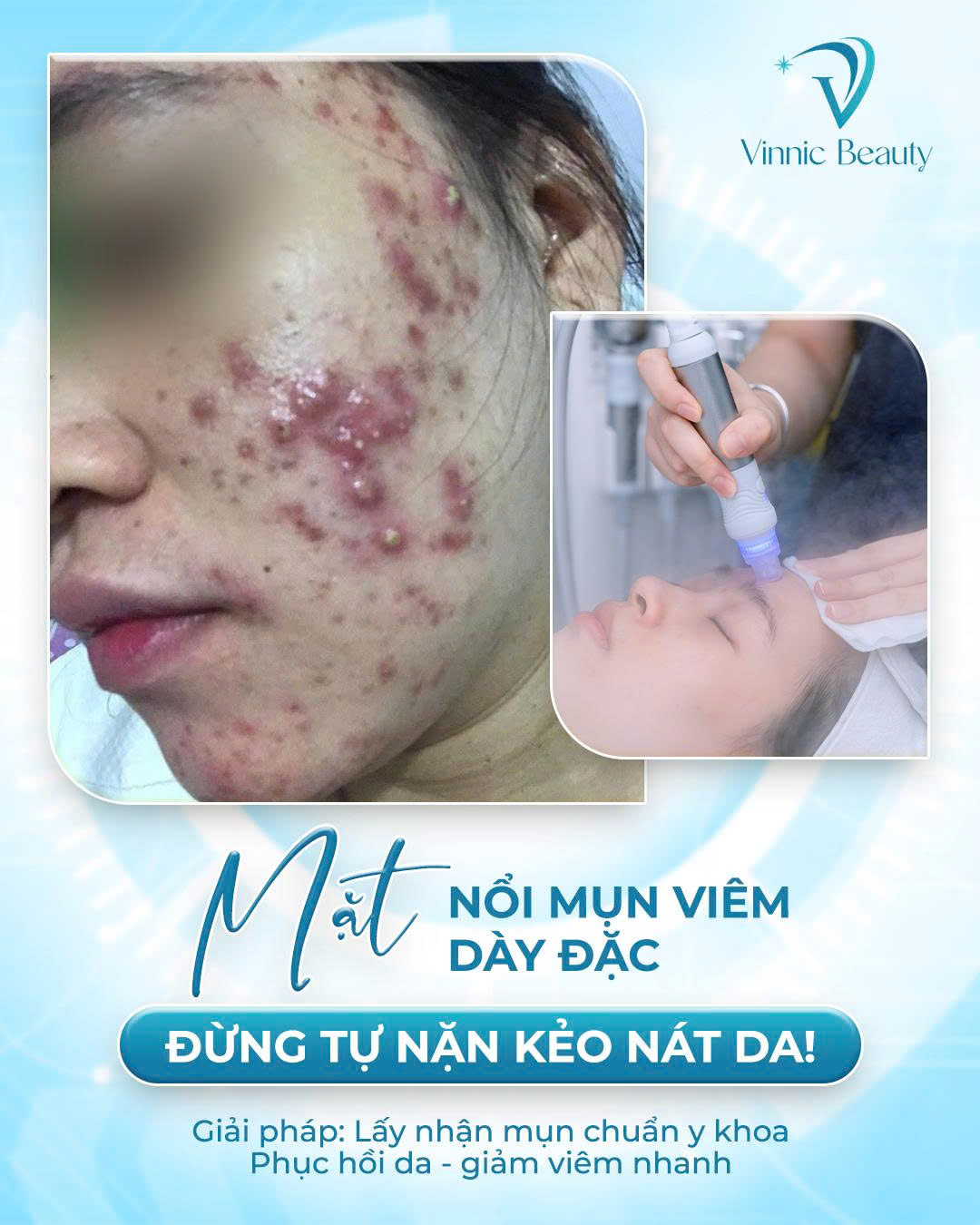 Mụn Tái Phát (1)