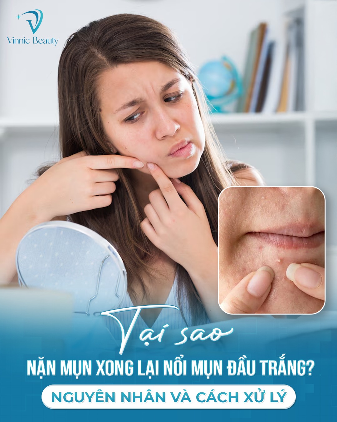 Nặn Mụn Xong Sao Lại Nổi Mụn Trắng? Bác Sĩ Da Liễu Giải Đáp 3 Nặn Mụn Xong Sao Lại Nổi Mụn Trắng Bác Sĩ Da Liễu Giải Đáp (3)