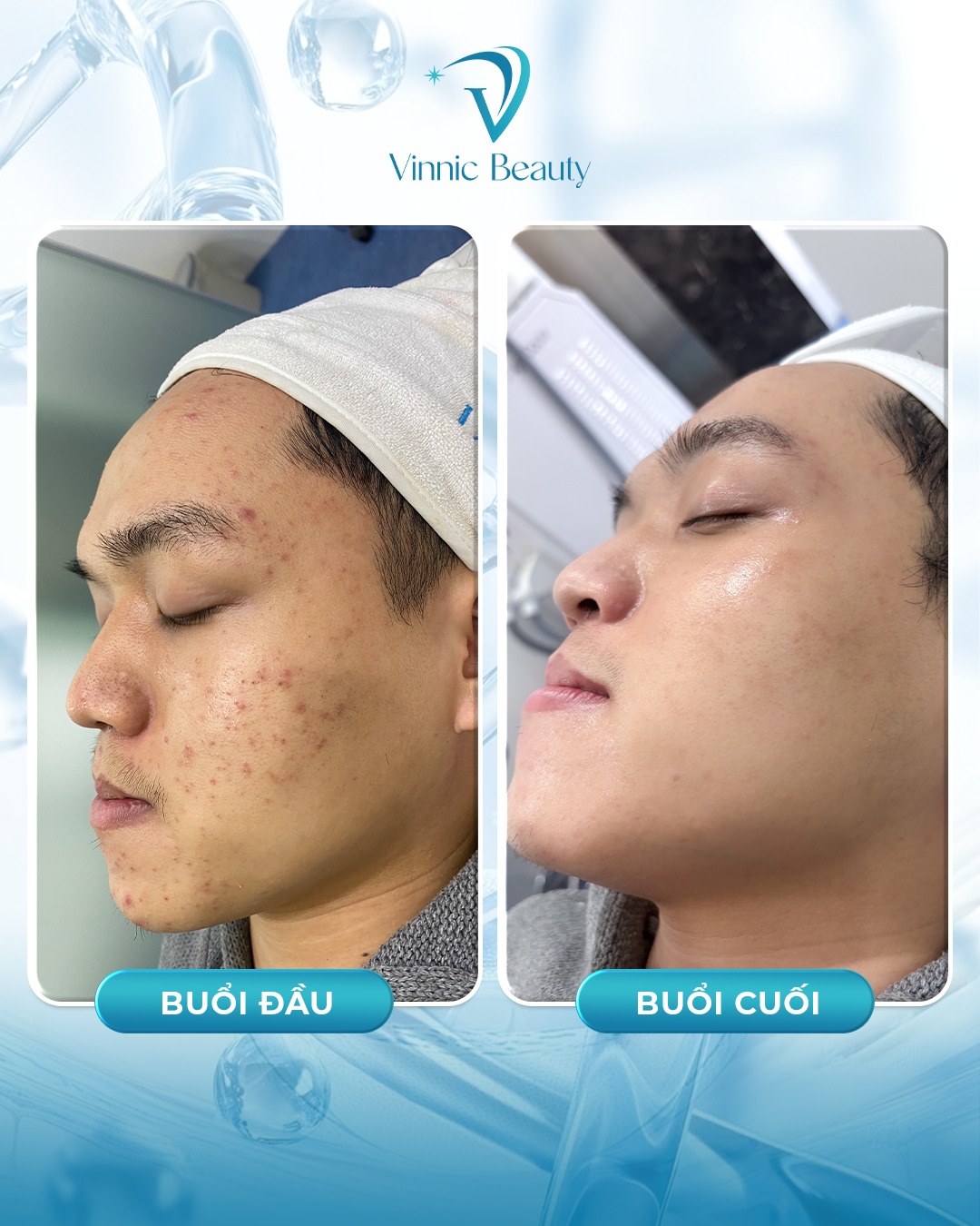 Nguyên nhân thật sự gây mụn và cách phòng ngừa hiệu quả (2)