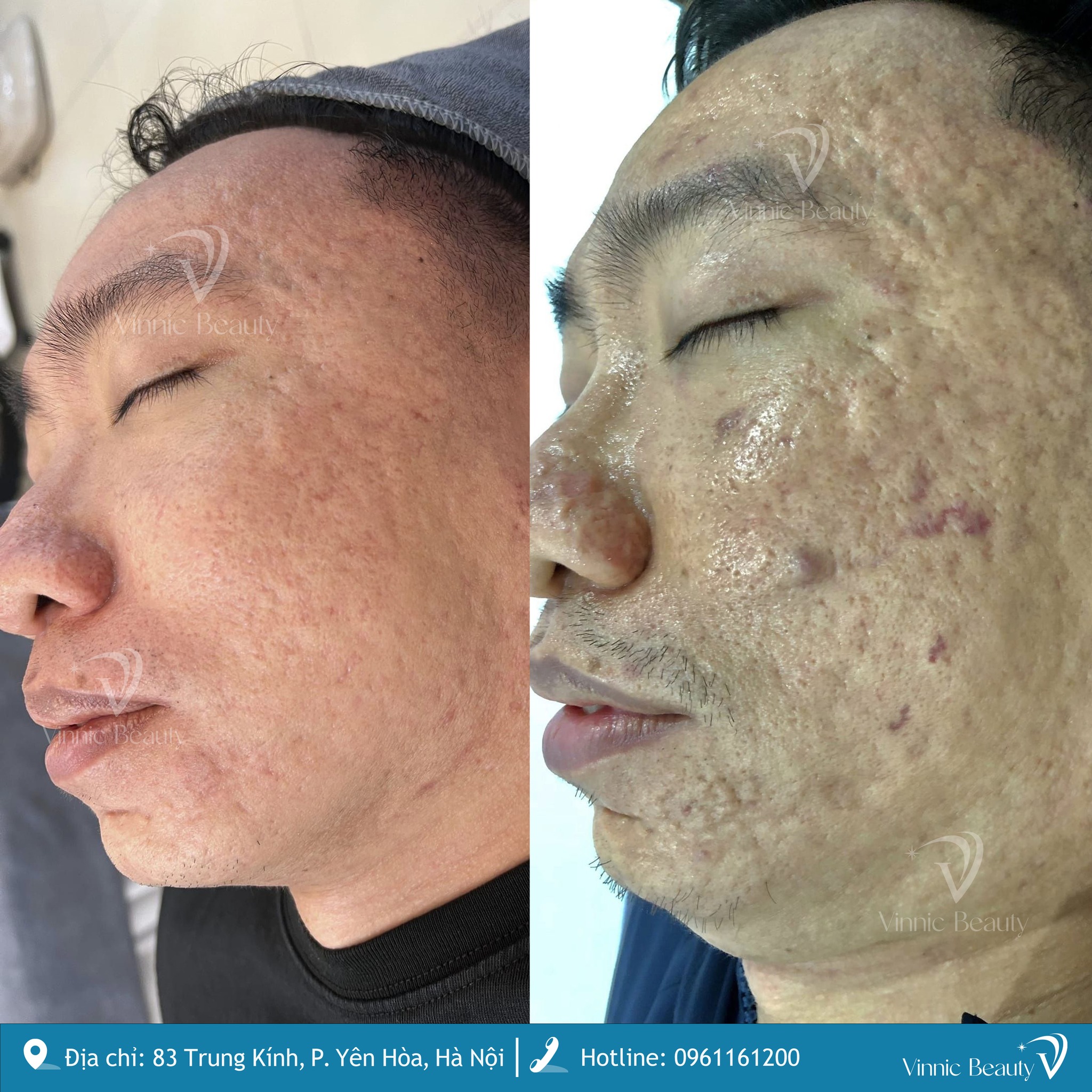 Tự Ti Vì Sẹo Rỗ Lâu Năm? Giải Pháp Trị Dứt Điểm Tại Trung Tâm Da Liễu Vinnic Beauty 4 Sẹo Rỗ Lâu Năm (1)