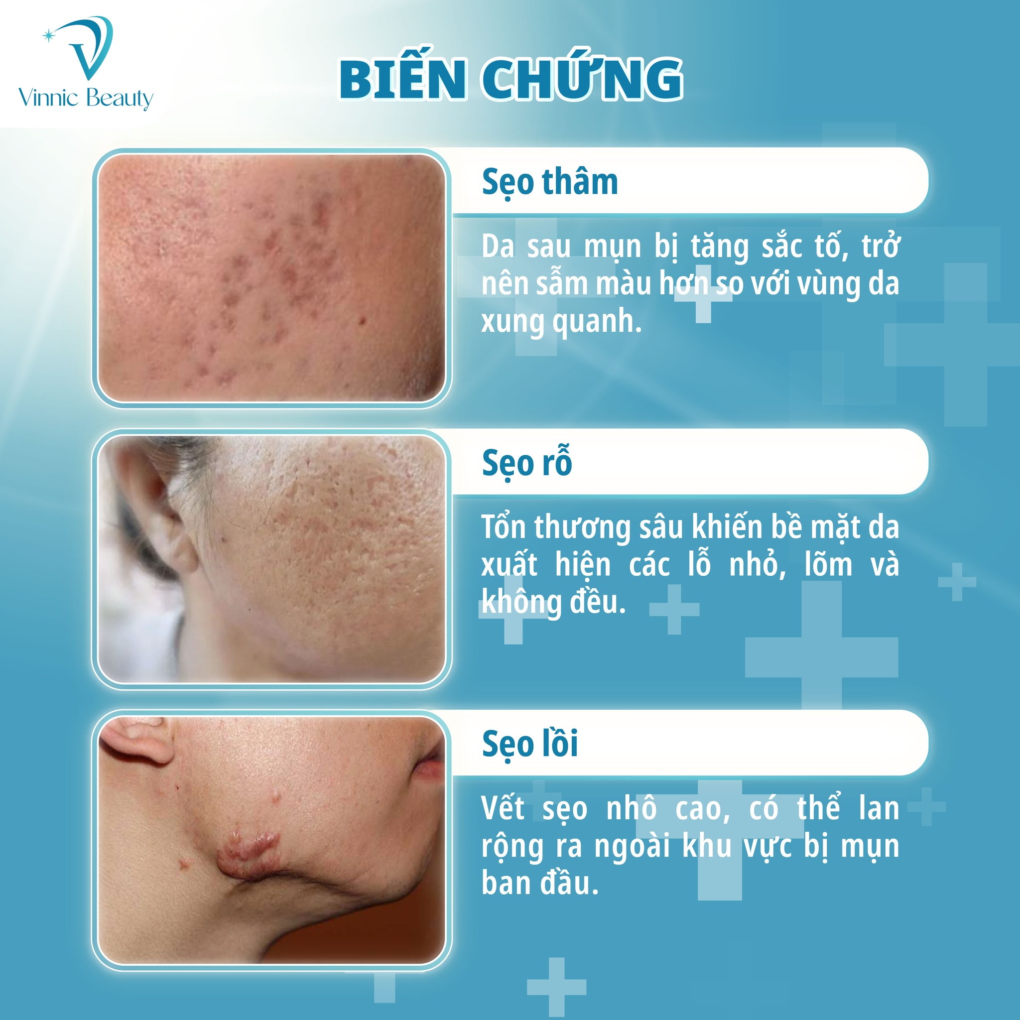 Sẹo Rỗ Lâu Năm (2)
