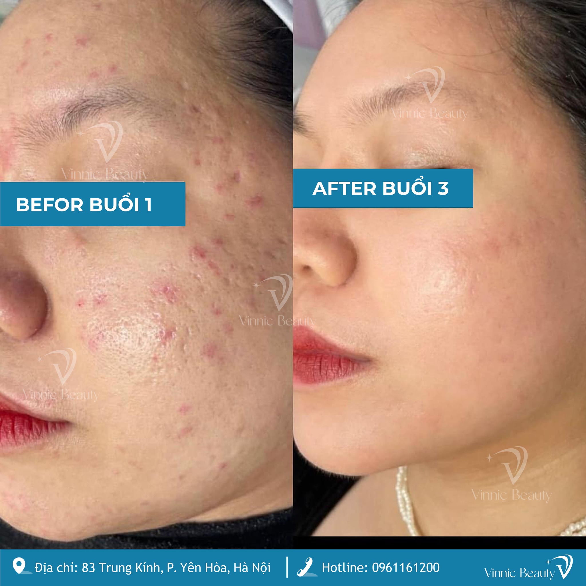 Tự Ti Vì Sẹo Rỗ Lâu Năm? Giải Pháp Trị Dứt Điểm Tại Trung Tâm Da Liễu Vinnic Beauty 2 Sẹo Rỗ Lâu Năm (3)