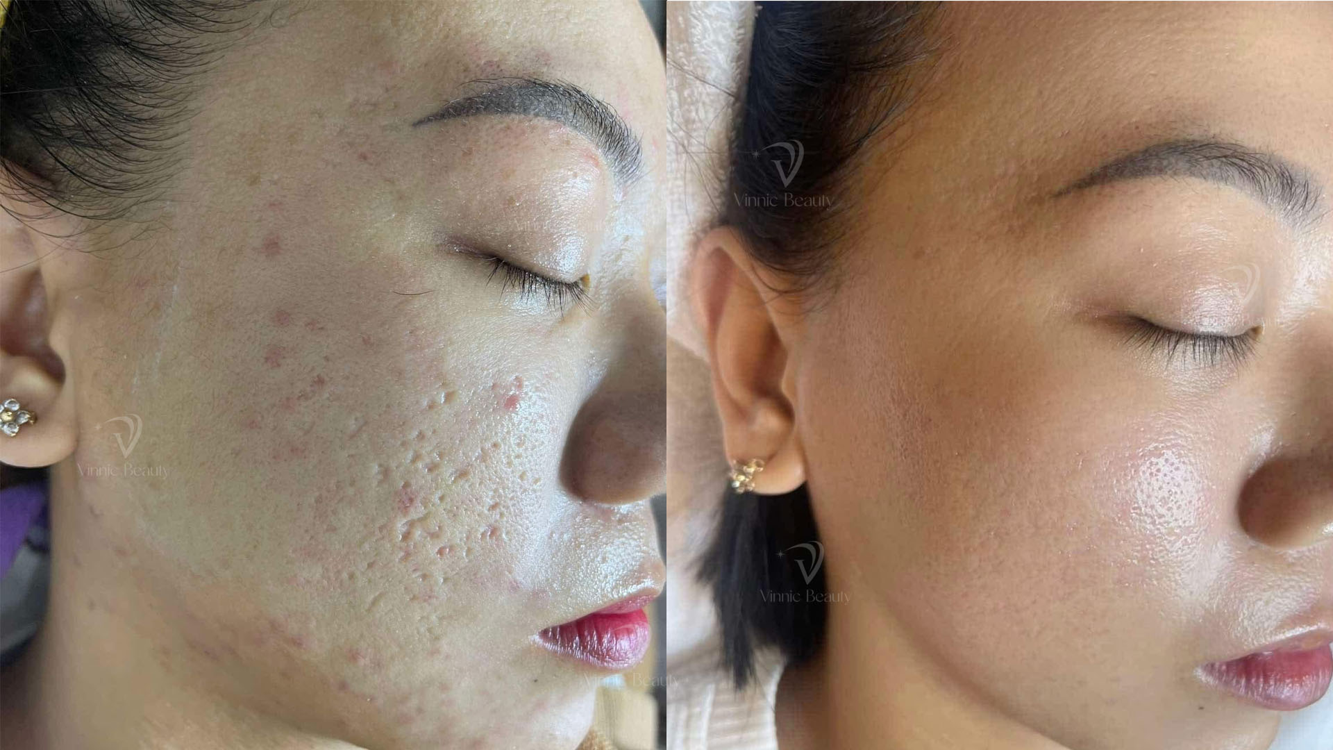 Các Loại Sẹo Rỗ Và Công Nghệ Điều Trị Phù Hợp Nhất Hiện Nay 3 Seo ro V1