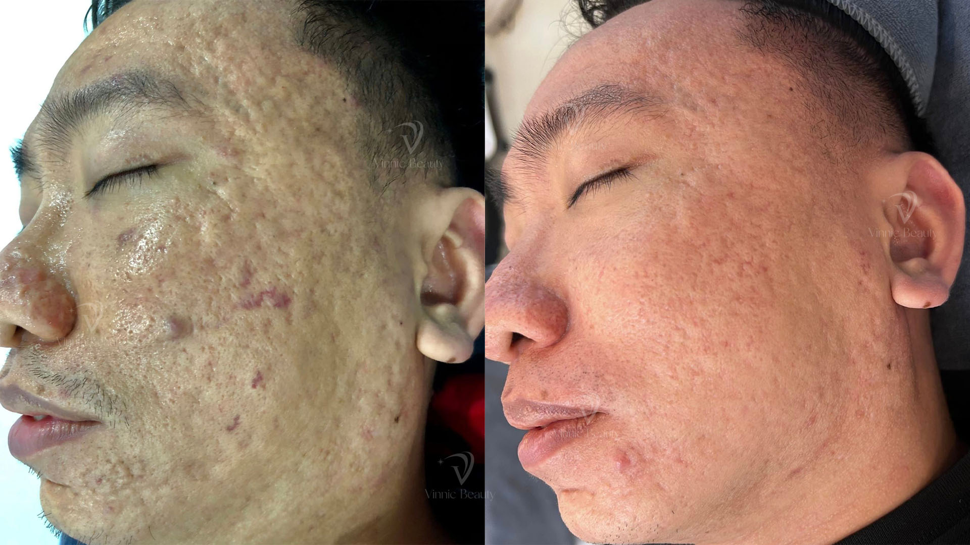 Seo ro V2