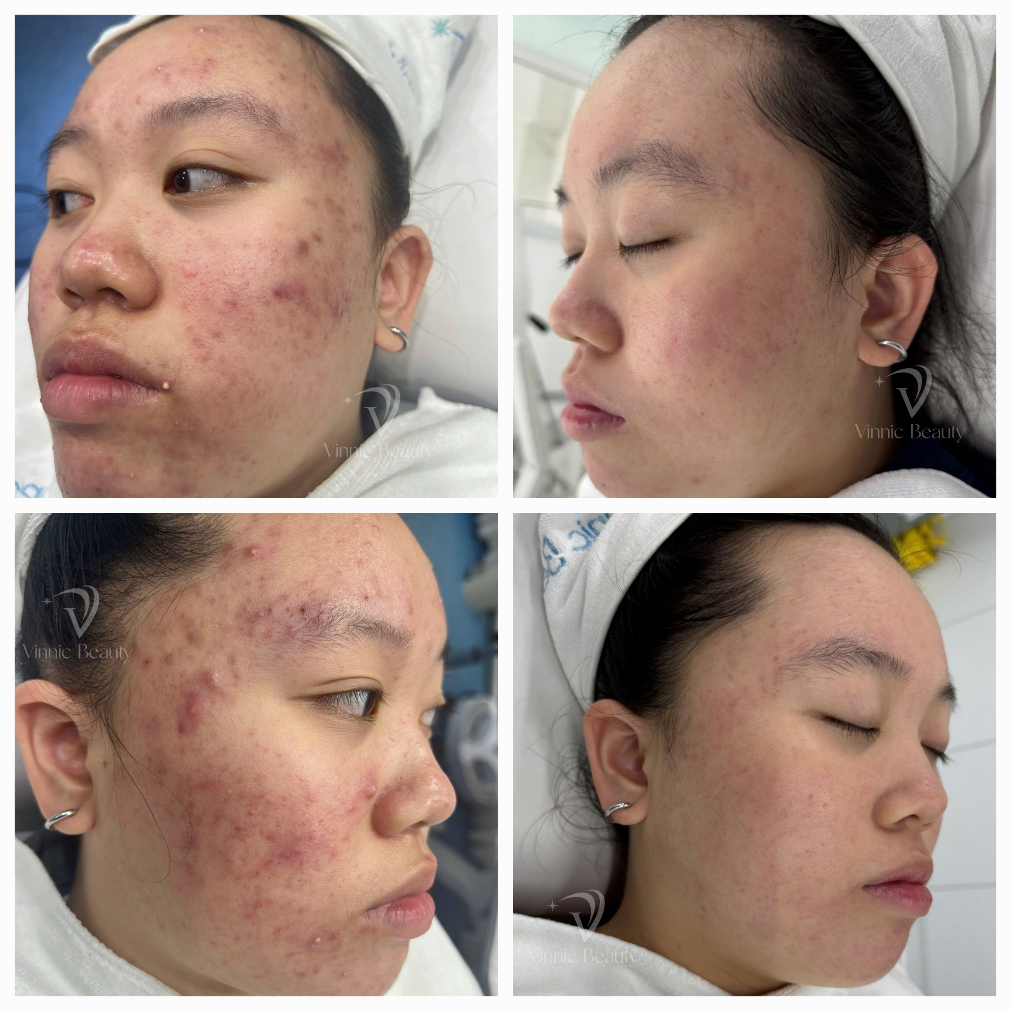 Trị Mụn Hiệu Quả với Atrix Pro+ – Kết Hợp Kỹ Thuật & Công Nghệ Tiên Tiến 3 Trị Mụn Hiệu Quả với Atrix Pro+ (4)