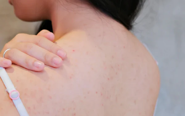Top 7 Cách Trị Mụn Lưng Tuổi Dậy Thì An Toàn, Không Để Lại Sẹo 2 Trị Mụn Lưng Tuổi Dậy Thì
