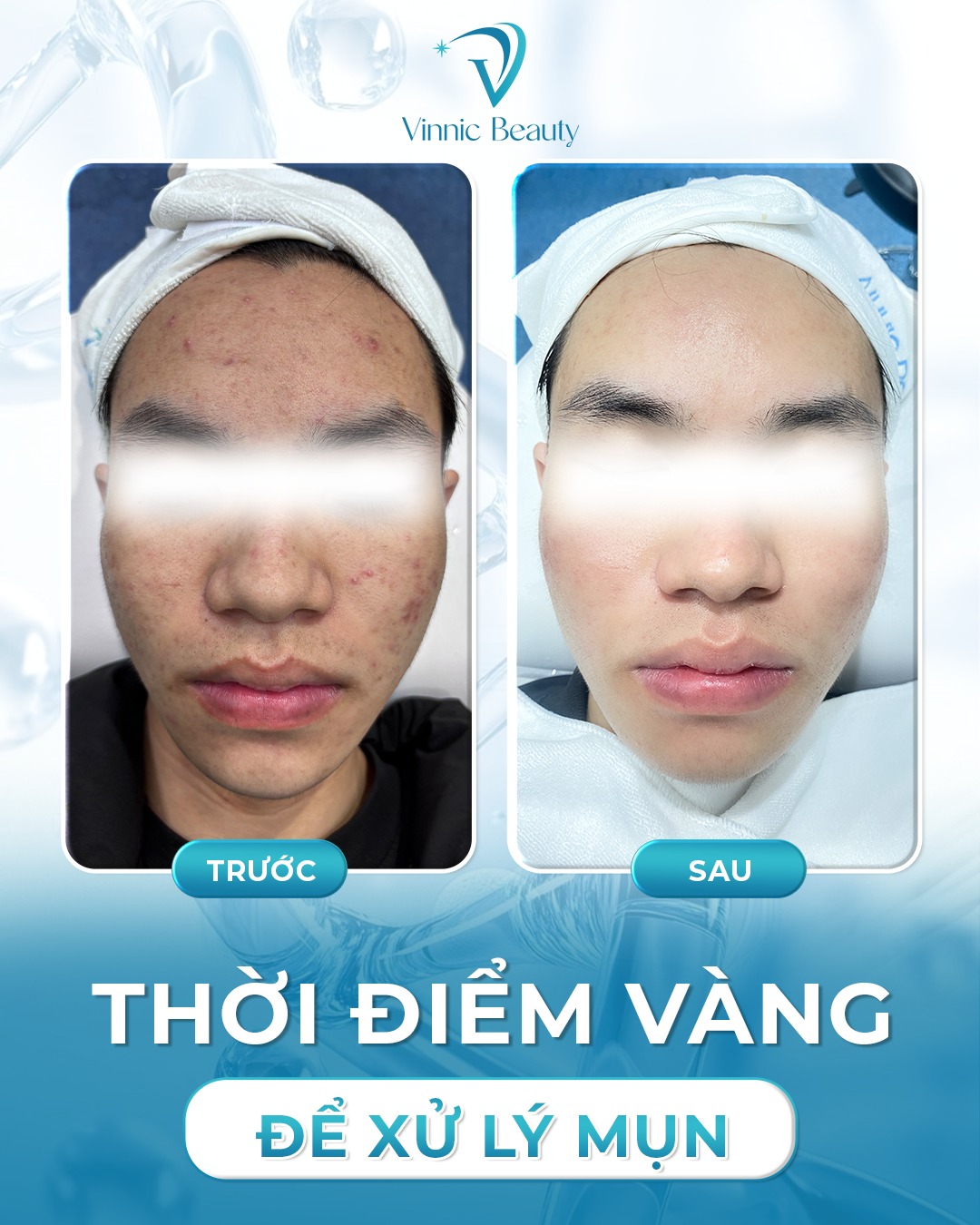 Trị Mụn Mãi Không Hết Có Thể Bạn Đang Sai Ngay Từ Đầu (3)