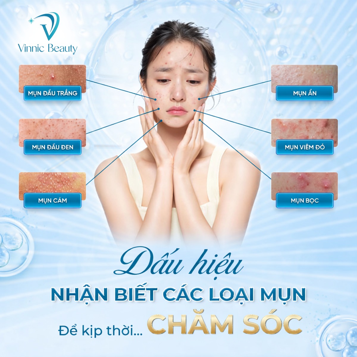 Trị Mụn Mãi Không Hết? Có Thể Bạn Đang Sai Ngay Từ Đầu 3 Trị Mụn Mãi Không Hết Có Thể Bạn Đang Sai Ngay Từ Đầu