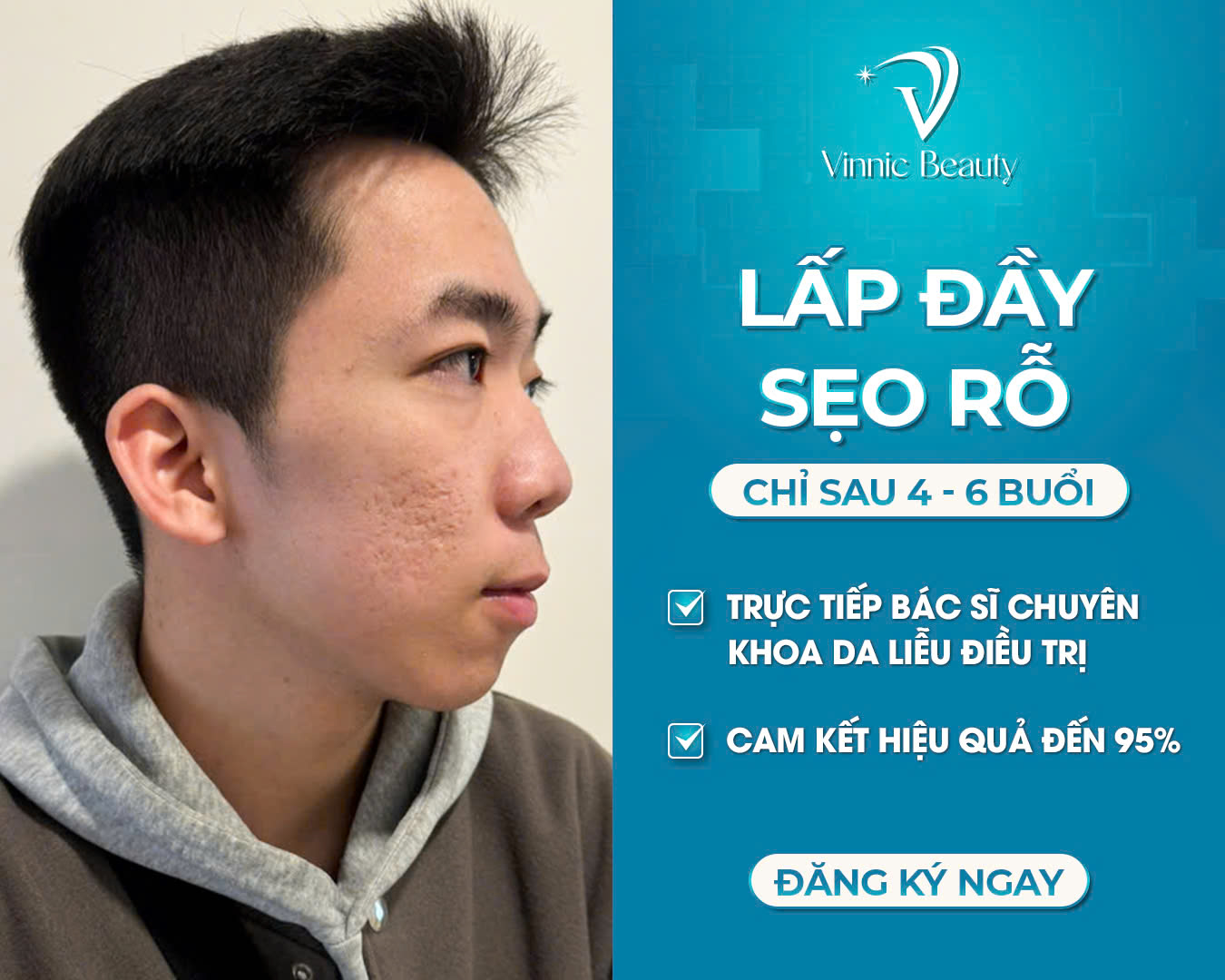 Trị Sẹo Rỗ: Càng Để Lâu Càng Khó Xóa Vĩnh Viễn – Đừng Chờ Đến Muộn! 2 Trị Sẹo Rỗ Càng Để Lâu Càng Khó Xóa Vĩnh Viễn – Đừng Chờ Đến Muộn! (2)