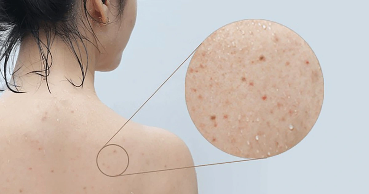 Trị mụn lưng chuẩn y khoa 4
